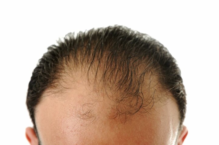 Frontale fibroserende alopecia